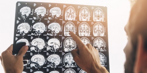 ALS Diagnosis: 6 Diagnostic Tests Doctors Use To Exclude Other Diseases and Diagnose ALS